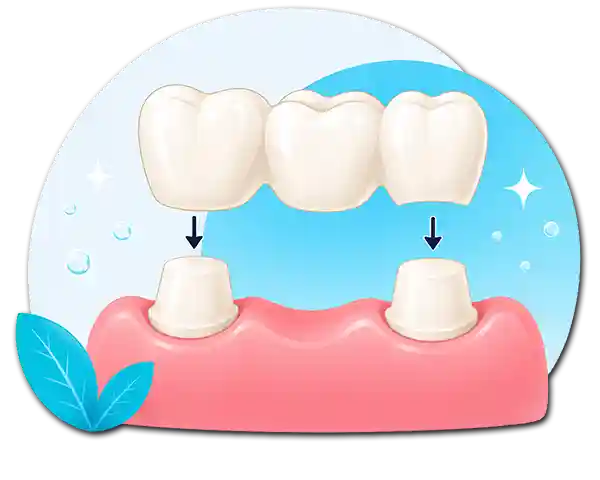 Shettleston Smile Bridge Placement Image