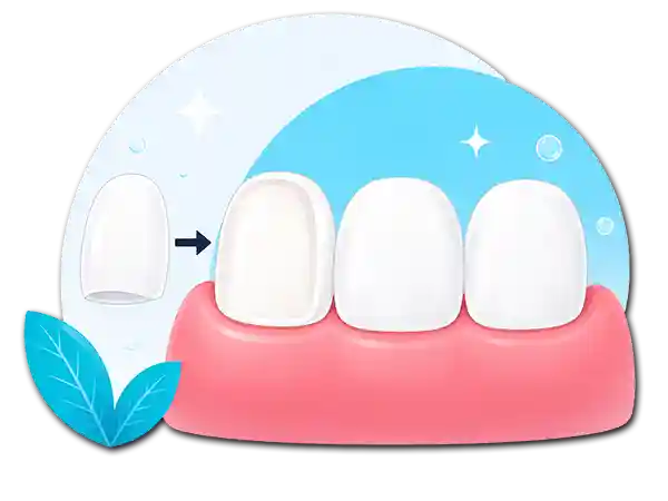 Shettleston Smile Dental Veneers