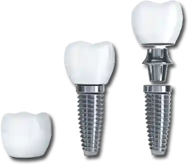 Shettleston Smile NHS Dentist Dental Implant