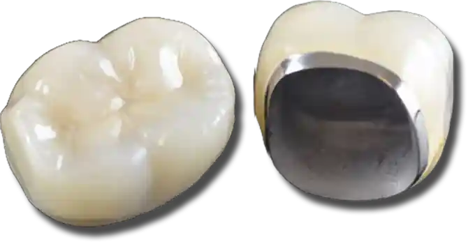 Shettleston Smile NHS Dentist Metal Ceramic Crown