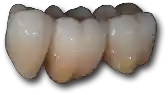 Shettleston Smile NHS Dentist Zirconia Bridge